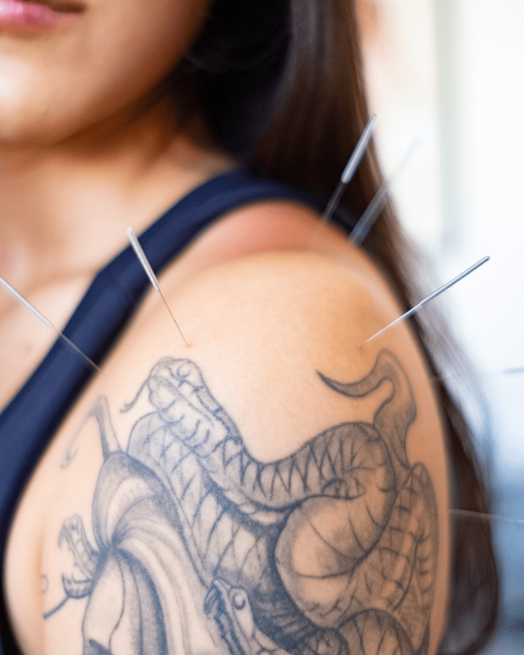 Dry Needling em Vila Madalena na Clínica TAZ